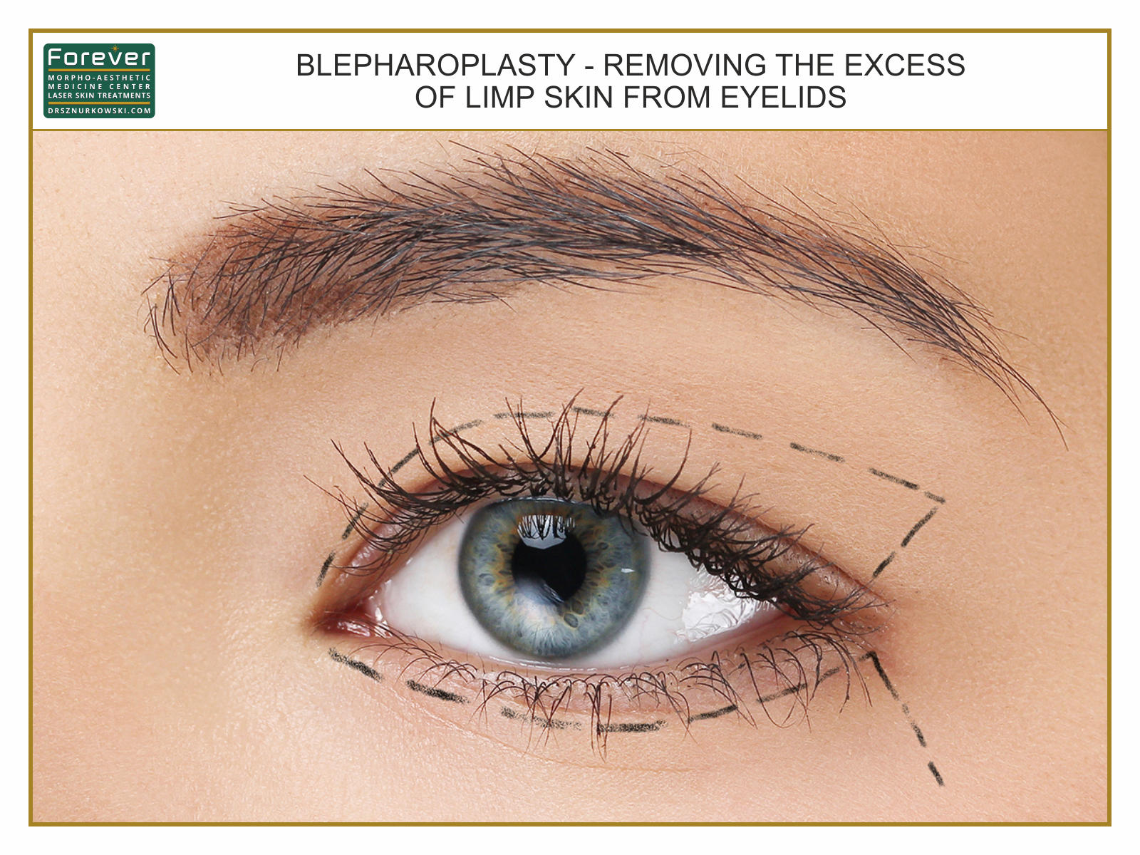 Blepharoplasty - Removing The Excess of Limp Skin From Eyelids 2 (80x60) EN.jpg