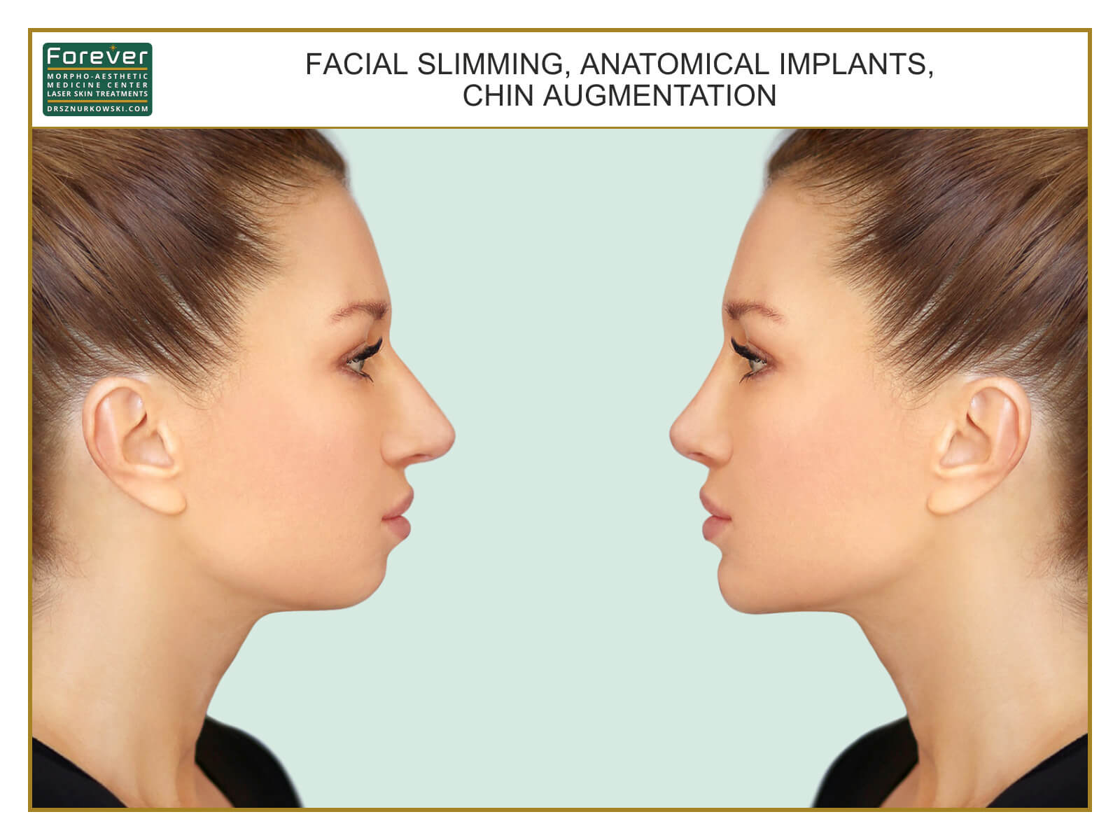 Facial Slimming, Anatomical Implants, Chin Augmentation (80x60) EN.jpg