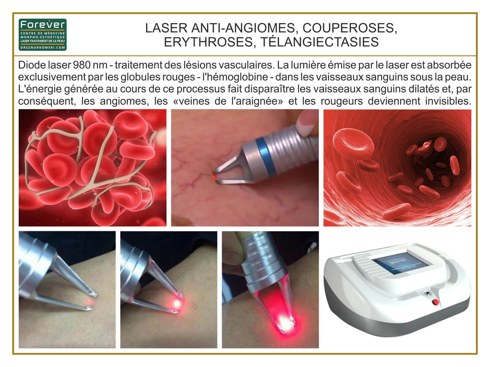 Anti-Vascular Laser, Rosacea, Erythrosis, Spider Veins... (80x60) FR.jpg