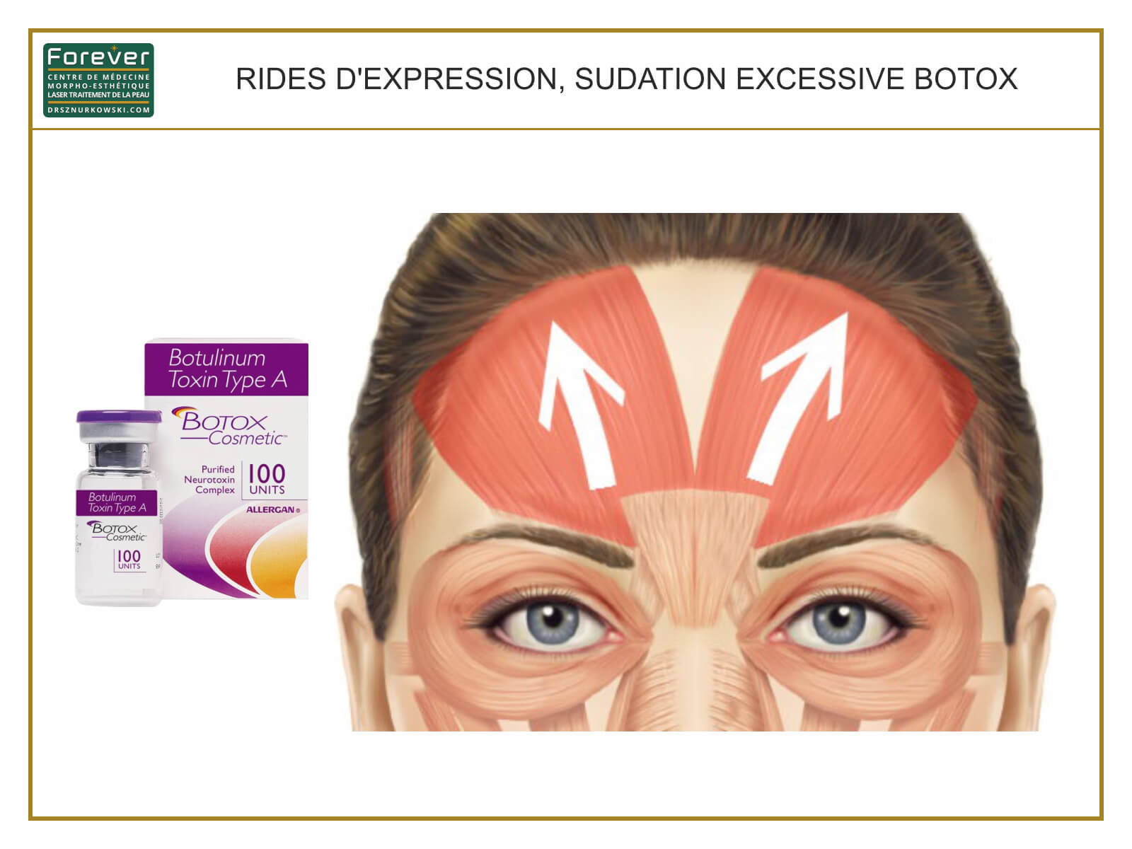 Botox - Expression Wrinkles, Excessive Sweating (80x60) FR.jpg