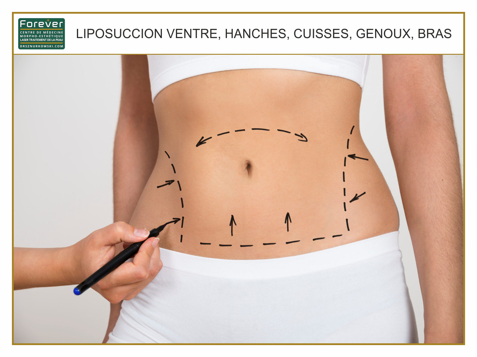 Liposuccion Ventre, Hanches, Cuisses, Genoux, Bras.jpg