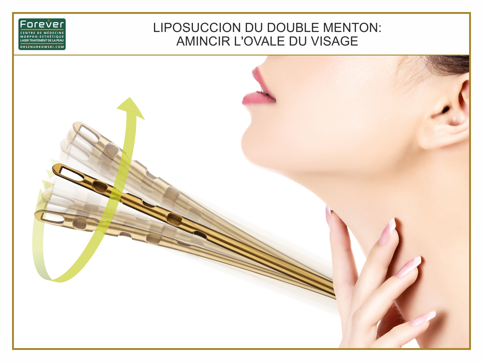 Liposuccion du double menton amincir l'ovale du visage.jpg