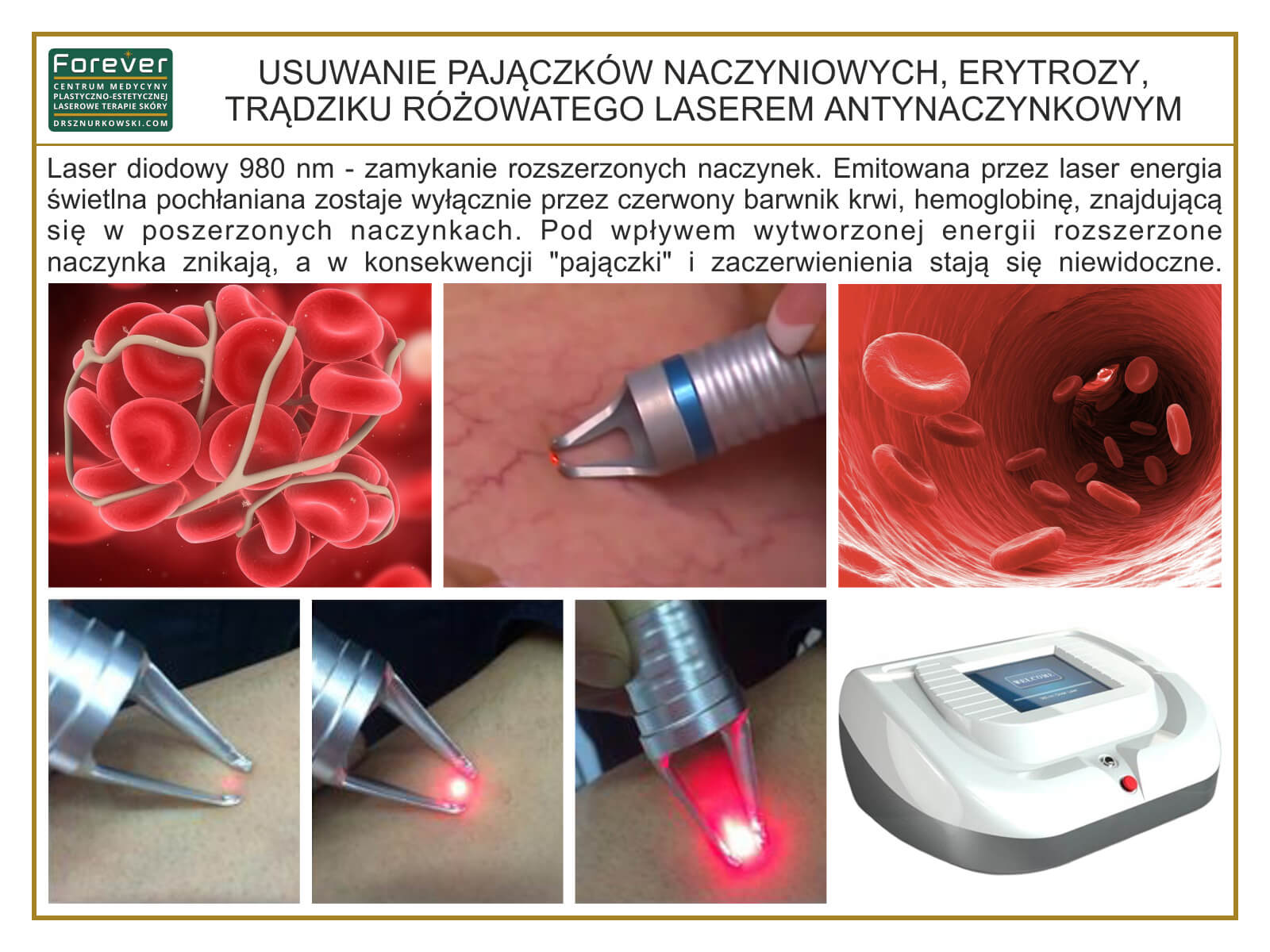 Anti-Vascular Laser, Rosacea, Erythrosis, Spider Veins... (80x60) PL.jpg